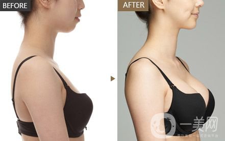 隆胸有幾種方法 哪種方法比較好？