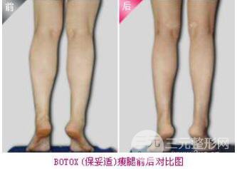 打注射瘦腿要多少錢?注射注射瘦腿價格?