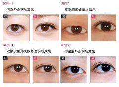 廣州雙眼皮手術多少錢