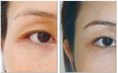 豐太陽穴手術的價格一般是多少