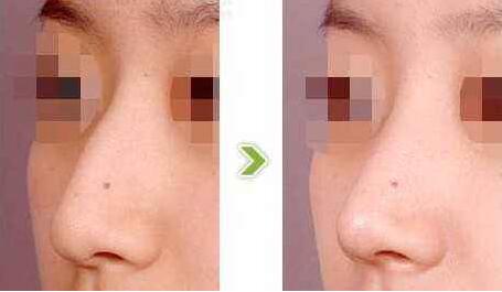 駝峰鼻有哪些類型？駝峰鼻矯正方法全解