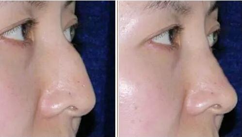 駝峰鼻有哪些類型？駝峰鼻矯正方法全解