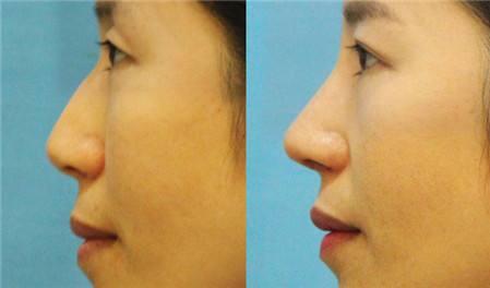 駝峰鼻整形術(shù)后注意事項有哪些？