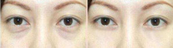 北京激光祛眼袋多少錢