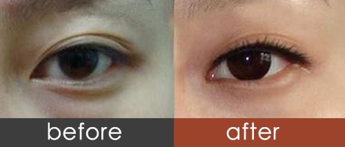 深圳內(nèi)切祛眼袋手術價格