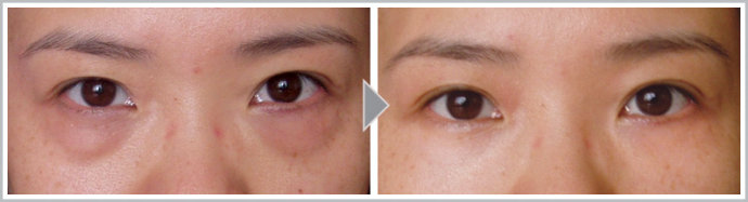 上海內(nèi)切祛眼袋費用是多少