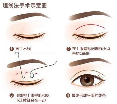 上海埋線(xiàn)雙眼皮價(jià)格多少
