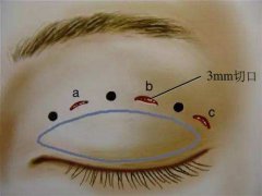 深圳韓式三點雙眼皮多少錢