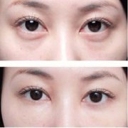 深圳激光祛眼袋手術(shù)價(jià)格是多少