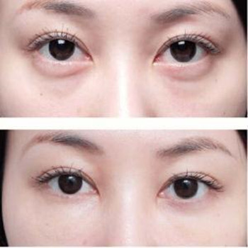 深圳激光祛眼袋手術(shù)價(jià)格是多少