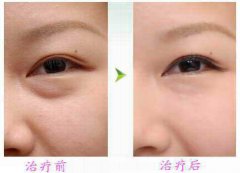 廣東手術祛眼袋價格