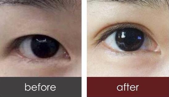 北京全切雙眼皮多少錢