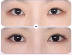 深圳眼部手術整形價格是多少