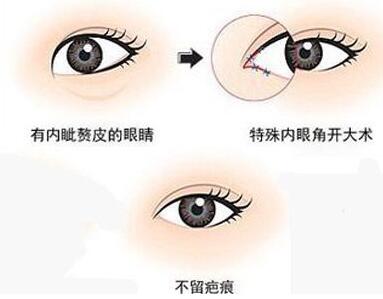 深圳開眼角多少錢