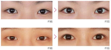 上海,開外眼角,多少錢