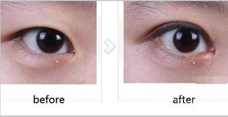 廣東,開(kāi)外眼角,價(jià)格