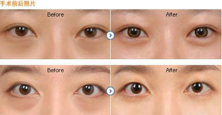 北京去黑眼圈多少錢