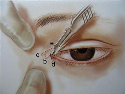 上海做開(kāi)眼角大概多少錢