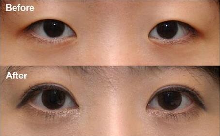 上海做開(kāi)眼角大概多少錢