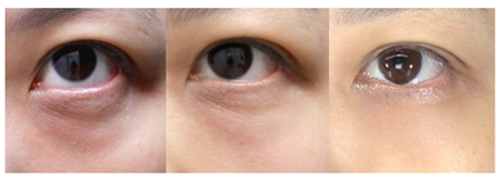 深圳去除黑眼圈手術(shù)價(jià)格是多少