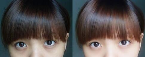 深圳激光去黑眼圈需要多少錢(qián)