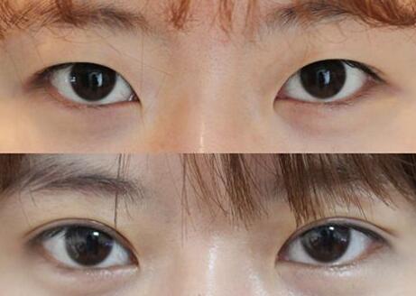 上海,*整形,多少錢