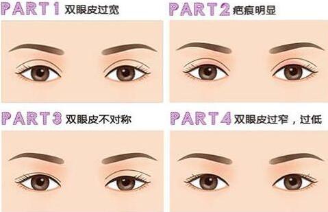 深圳眼部整形失敗修復需要多少錢