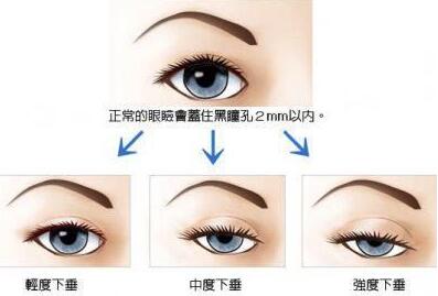 深圳下眼下至術(shù)需要多少錢