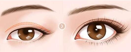 深圳下眼下至術(shù)需要多少錢