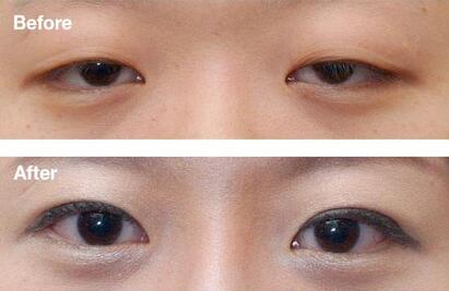 廣東下眼下至手術(shù)費用