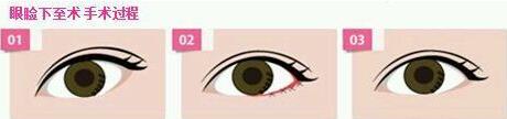 北京下眼下至術(shù)多少錢(qián)