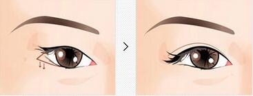 北京下眼下至術(shù)多少錢(qián)