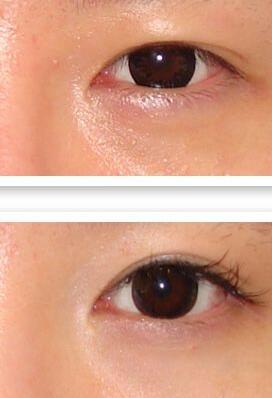 廣東上眼皮去脂價(jià)格