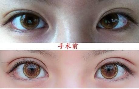 上海,眼瞼整形,手術費用