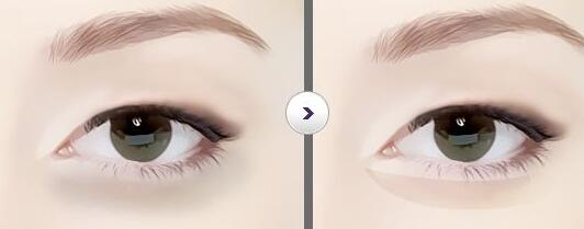 廣東,眼瞼整形,價格