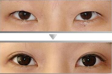 廣東,眼瞼整形,價格