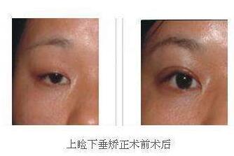 上海,上眼瞼提肌,手術,多少錢