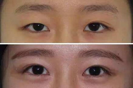 廣東,眼部提肌,多少錢