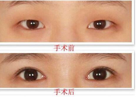 深圳,上眼皮提肌,多少錢