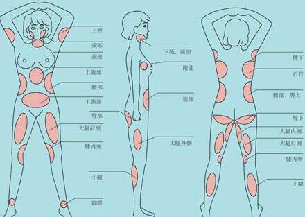 南京吸脂減肥價格是多少？