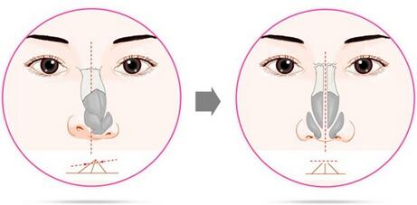 歪鼻矯正費用需要多少錢？