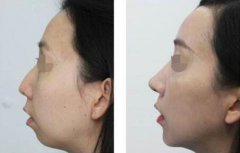 駝峰鼻多少錢 駝峰鼻矯正費用盤點