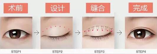 焊接雙眼皮是什么？有哪些特點(diǎn)？