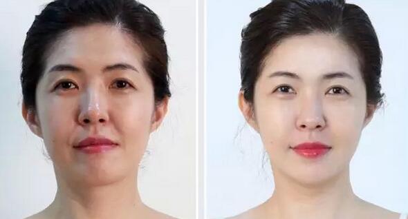 法令紋怎樣消除