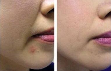 法令紋怎樣消除