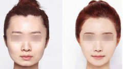 等離子激光溶脂價格是多少