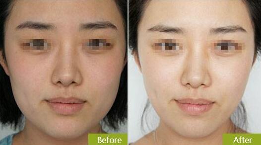 等離子激光溶脂價(jià)格是多少