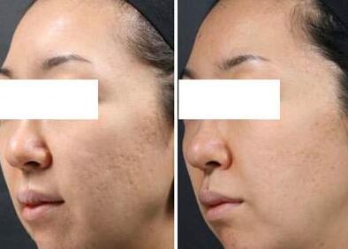 像素激光去痘坑*果怎么樣