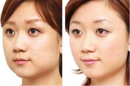 去頰脂墊價(jià)格是多少？貴不貴？