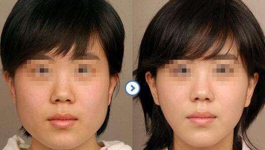 去頰脂墊價(jià)格是多少？貴不貴？